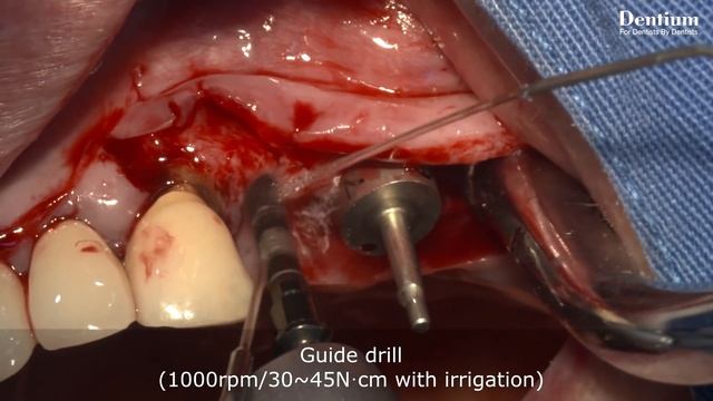 Sinus Lifting Using Osteotome