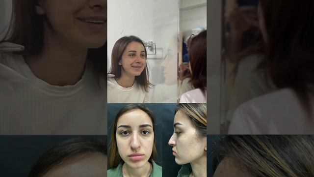 Снятие гипса и впечатление после ринопластики.Великолепный пластический хирург-Норайр Валерьевич смотреть онлайн