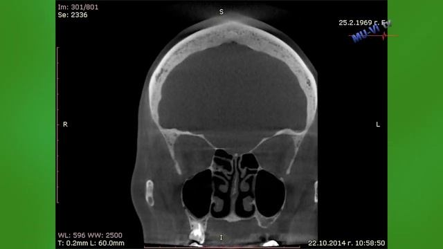 Синузит - какво все още не сме научили за него? смотреть онлайн