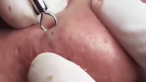 Выдавливание чёрных точек.