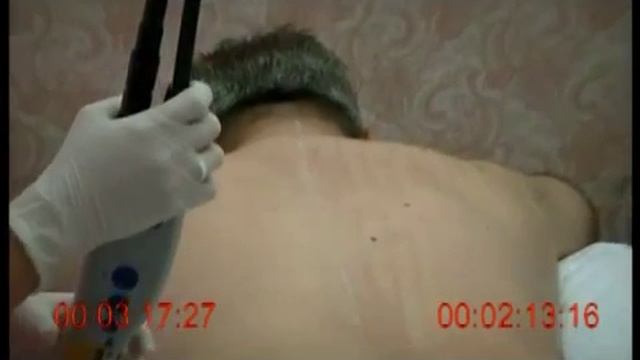 Asclepion MeDioStar NeXT vs. Gentlelase: сравнение скорости проведения лазерной эпиляции смотреть онлайн