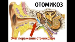 Отомикоз (грибок в ушах)
