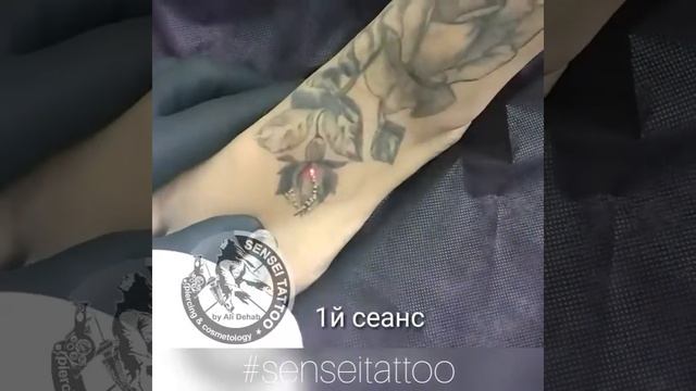 Удалить татуировку лазером на ноге Днепр смотреть онлайн