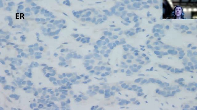 Tip-91;Her-2/neu Positive Invasive Lobular Carcinoma смотреть онлайн