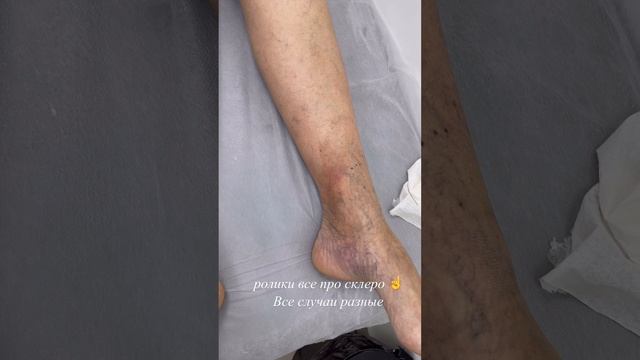 Сосудистая сетка. Узловая эритема. Пигментация кожи. Склеротерапия противопоказана. Флеболог Москва