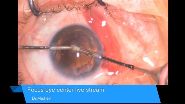 Lentis Comfort EDOF Lukan Mishev Live Stream смотреть онлайн