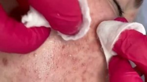 ВЫДАВЛИВАНИЕ ЧЕРНЫХ ТОЧЕК НА НОСУ