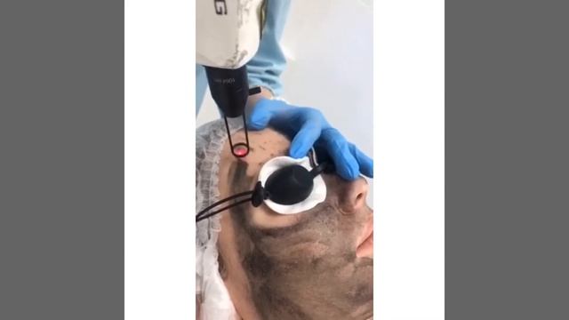 Карбоновый пилинг смотреть онлайн