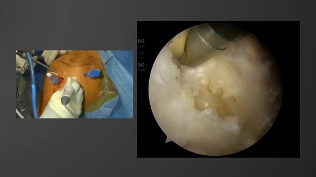 Arthroscopic Biceps Tenodesis: Applications and Technique смотреть онлайн
