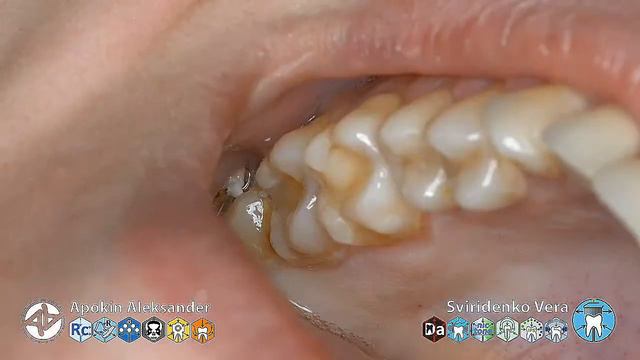 Extraction of a dystopian tooth 18 under Ubistezin FORTE (multistream) смотреть онлайн