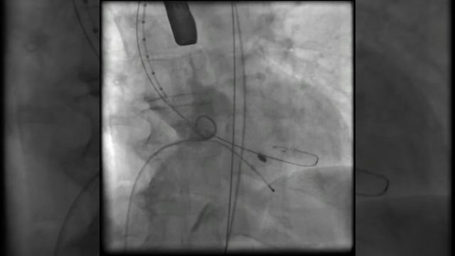 Аортальный клапан после баллонной вальвулопластики. смотреть онлайн