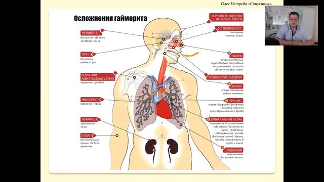 Синуситы. Причины и осложнения. Азбука здоровья. смотреть онлайн
