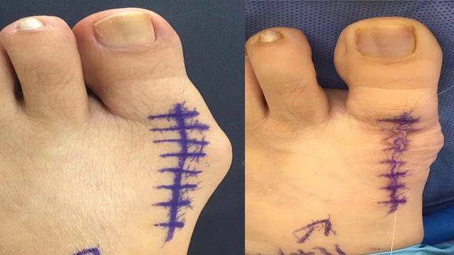 The TRUTH about Bunion Surgery *FASTEST possible recovery* смотреть онлайн