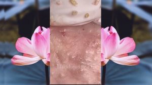 Выдавливание чёрных точек НОВОЕ! Удаление чёрных точек за ухом. p16