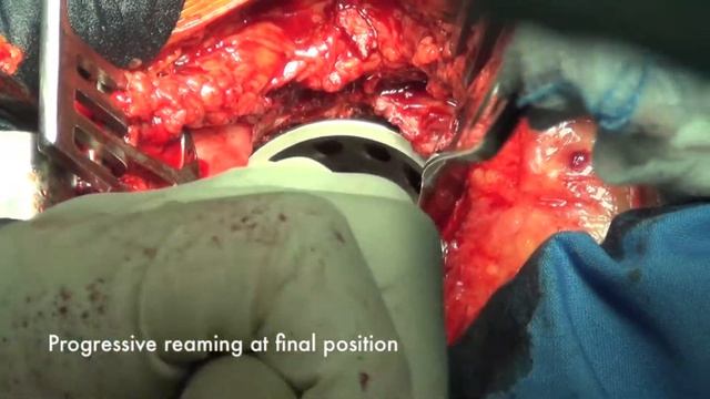 Evolutis - Live Surgery - Dual Mobility смотреть онлайн