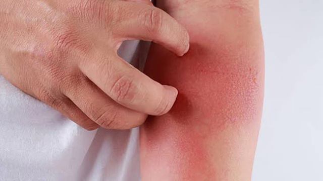 Best Use Of Travocort Cream | Pustular Psoriasis | Eczema On Legs | Eczema Dry Skin | Eczema Patche