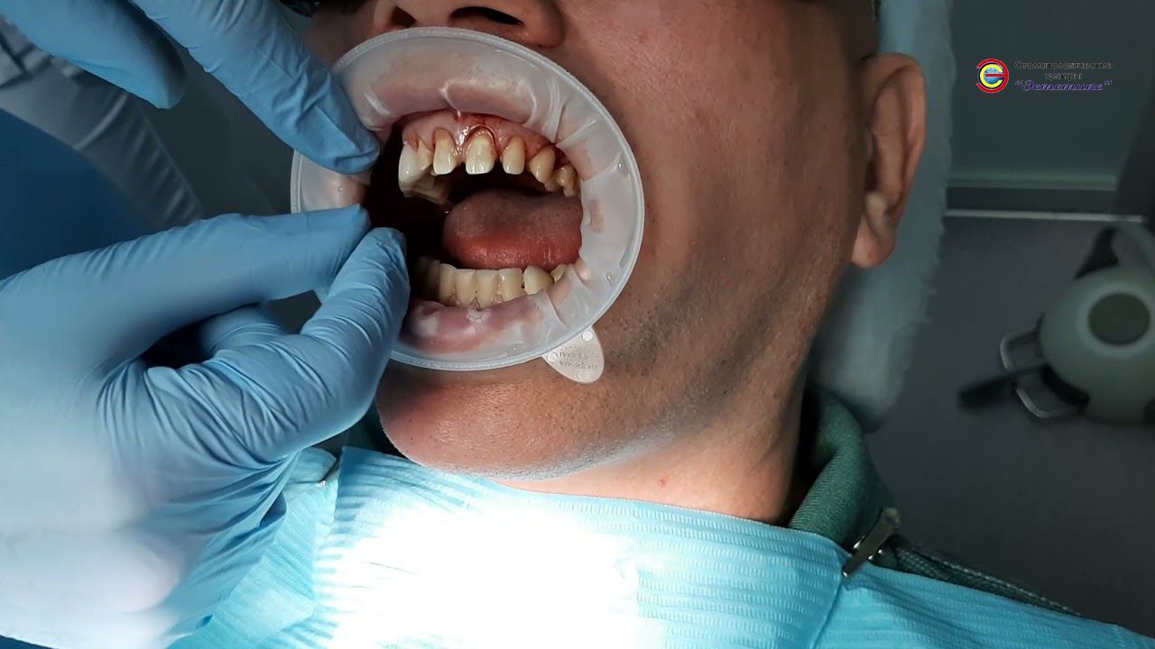 Виниры в Москве. Работа стоматолога-ортопеда-терапевта Бондаренко Юрия Ивановича смотреть онлайн