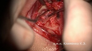 Тимпанопластика