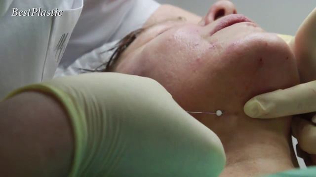 Процедура «Нити» смотреть онлайн