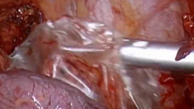Systematic mediastinal nodal dissection by VATS смотреть онлайн