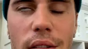 У Джастина Бибера паралич лицевого нерва