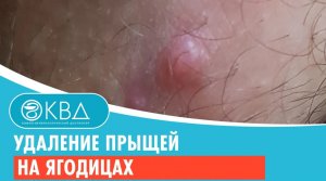 ✅ Удаление прыщей на ягодицах. Клинический случай №645