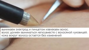 Как делать электроэпиляцию