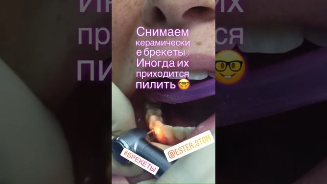 Снятие керамического Брекета смотреть онлайн