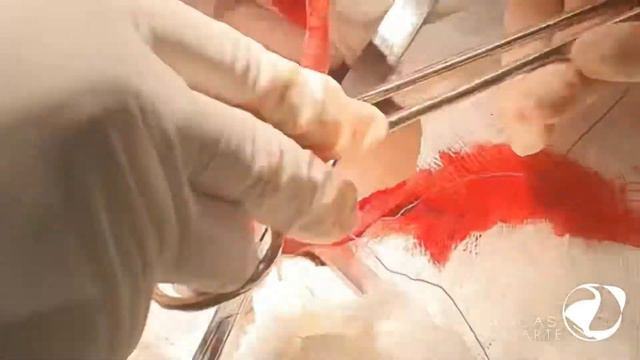 Apendicectomia Convencional • Conventional Appendectomy - DR. LUCAS DUARTE [01NOV21] смотреть онлайн