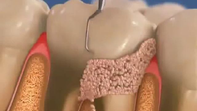 Процесс удаления зубного камня смотреть онлайн