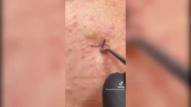 Popping huge blackheads and Pimple Popping - Best Pimple Popping Videos #31 смотреть онлайн