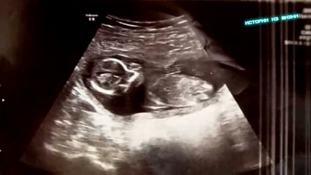 Доктора готовились очистить матку женщины и напоследок решили сделать УЗИ…Через секунду все побелел смотреть онлайн