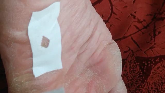 Как я применил салипод от сухих  мозолей на ноге