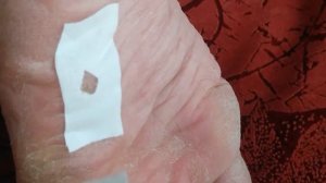 Как я применил салипод от сухих  мозолей на ноге