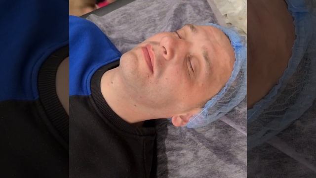 MezoPeel. Гликолевый пилинг +Фракционная Мезотерапия смотреть онлайн