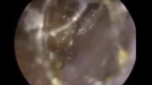 Извлечение огромного куска ушной серы из уха | Часть 4