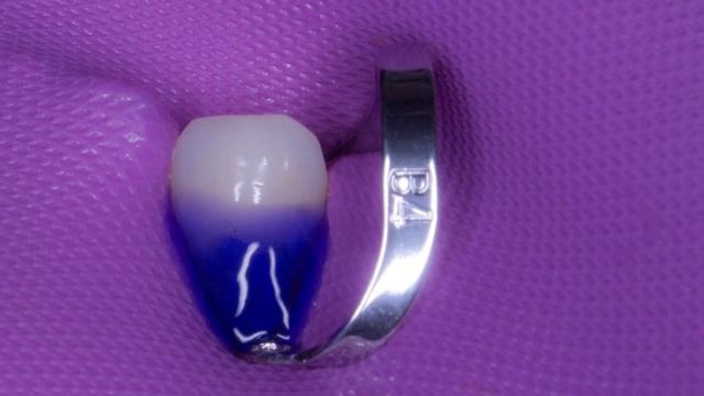 Пришеечный кариес зуба , коффердам , лечение зубов , постановка пломбы , dental dam , dental смотреть онлайн