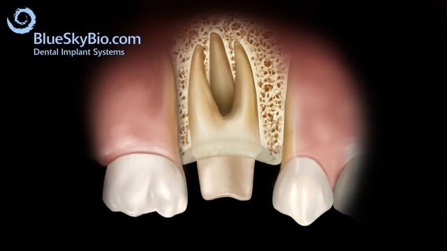 Patient Treatment Videos: Crown Lengthening смотреть онлайн
