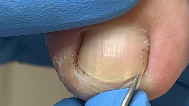 Solve The Patient's Ingrown Nails And Mud!【Xue Yidao】
