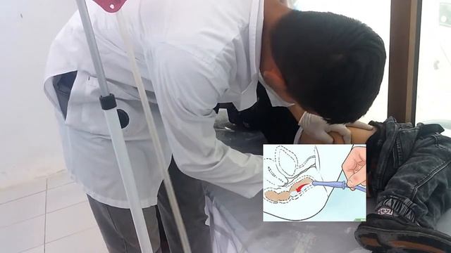 CLEANSING ENEMA. ENEMA. ADMINISTERING a CLEANSING ENEMA смотреть онлайн