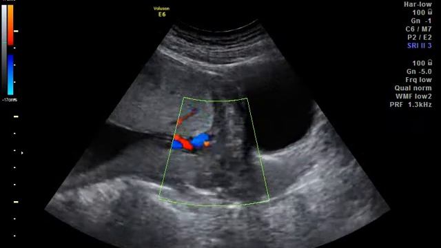 Ваза превия - VASA PREVIA смотреть онлайн