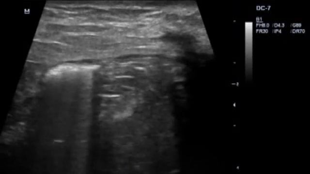 Грыжа передней брюшной стенки смотреть онлайн