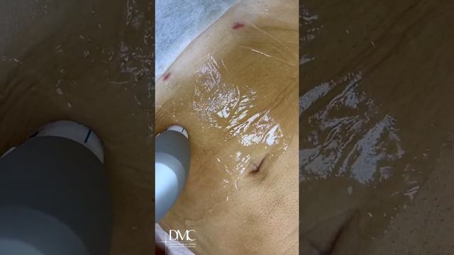 Ультразвуковая подтяжка кожи живота и уменьшение объёмов! смотреть онлайн