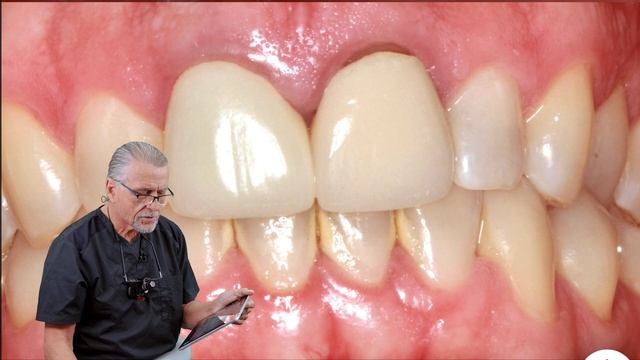Hidden killers of teeth | Toothache | Dental Restoration смотреть онлайн