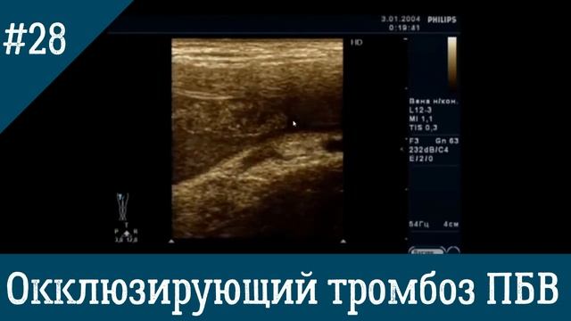 УЗИ вен. Окклюзирующий тромбоз ПБВ.