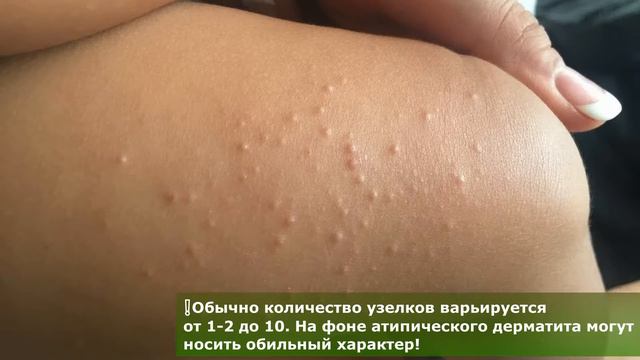 Контагиозный моллюск смотреть онлайн