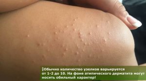 Контагиозный моллюск