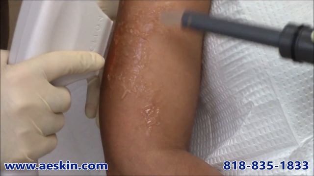 Forever Young BBL IPL Photofacial Demonstration 19 Arms - A E Skin - Encino, CA - 818-835-1833 смотреть онлайн