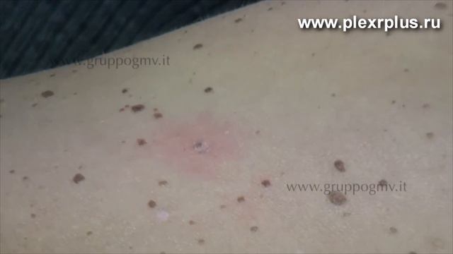 Обработка кератоза на аппарате Plexr Plus смотреть онлайн