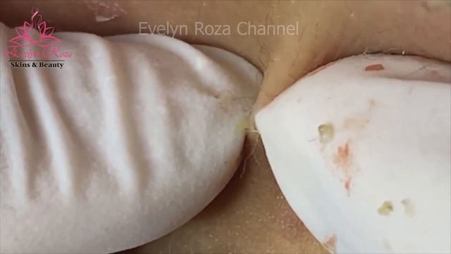 Old Blackheads Pimple Folliculitis Removal |Care Of Acne Treatment (#29) смотреть онлайн